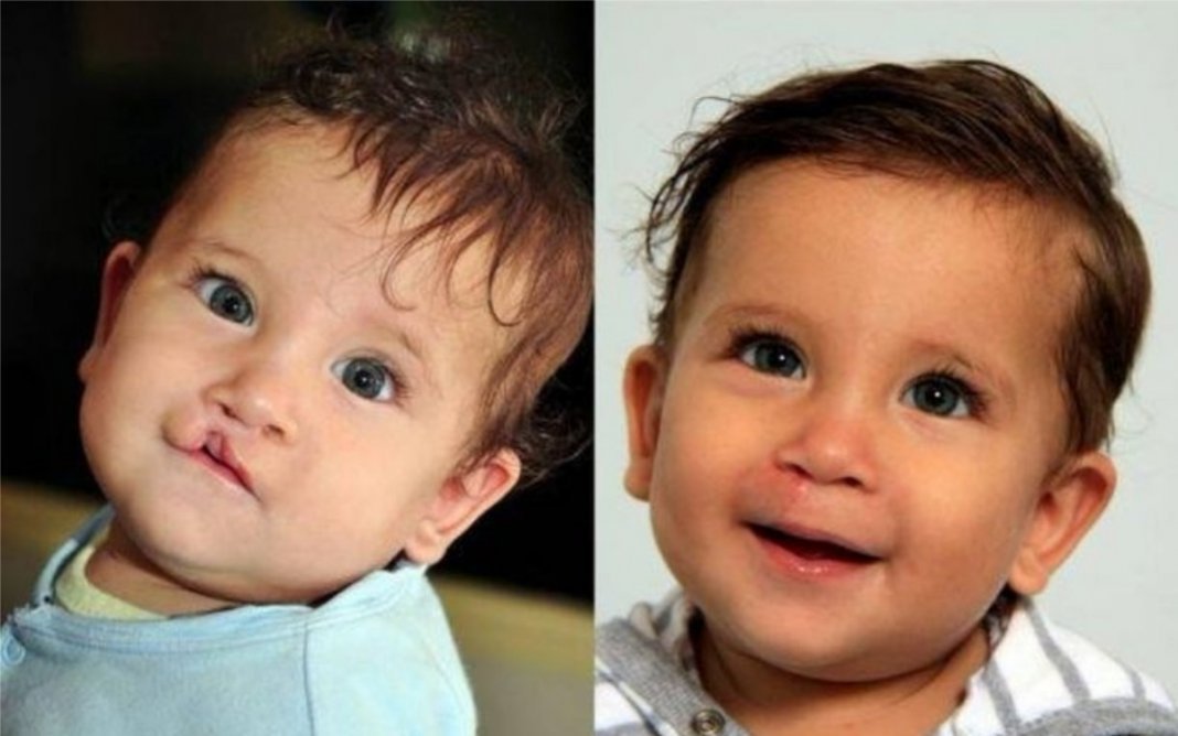 Дети без губ. Хейлосхизис (заячья губа). Ребенок с зайчтец губой. Дети с заячьей губой до и после.
